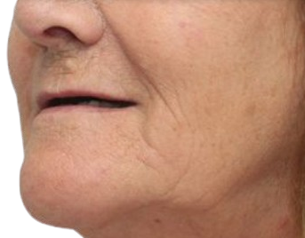 Prima del Trattamento