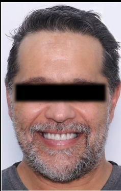 Dopo il Trattamento 2