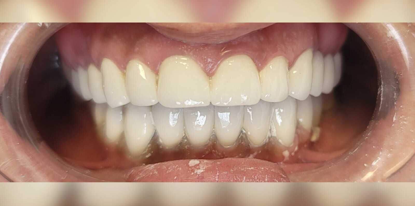 Dopo il Trattamento 4